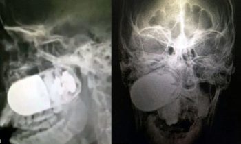 Badass Soldier Has A Live Grenade Pulled Out Of His Head & Lives!